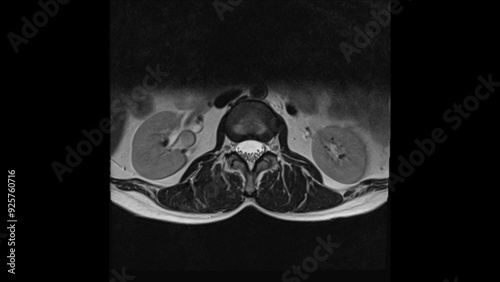 MRI scan of lumbar spines nomal axial T2