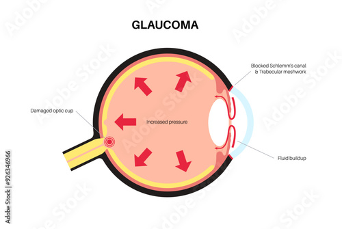 Glaucoma eye pressure