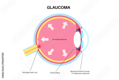 Glaucoma eye pressure