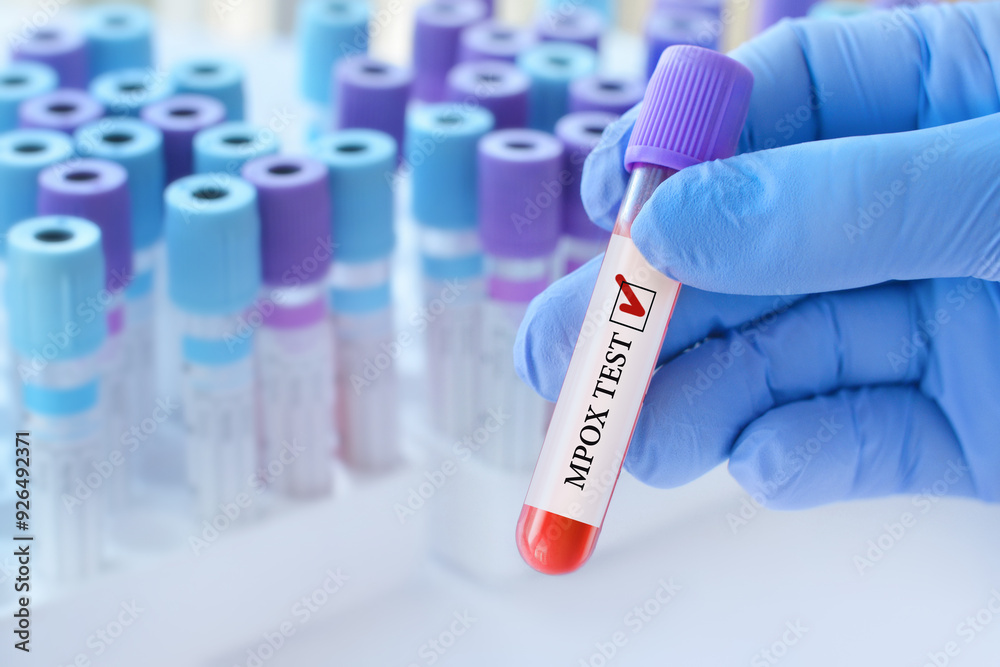 Doctor holding a test blood sample tube with Monkeypox virus (MPXV) .The virus is transmitted from animals to humans. Infected people suffer from fever, cough, headache, nausea and vomiting Doctor holding a test blood sample tube with Monkeypox virus (MPXV) .The virus is transmitted from animals to humans. Infected people suffer from fever, cough, headache, nausea and vomiting