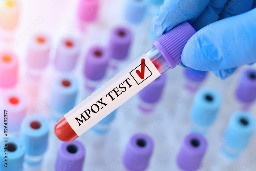 Obraz premium Doctor holding a test blood sample tube with Monkeypox virus (MPXV) .The virus is transmitted from animals to humans. Infected people suffer from fever, cough, headache, nausea and vomiting