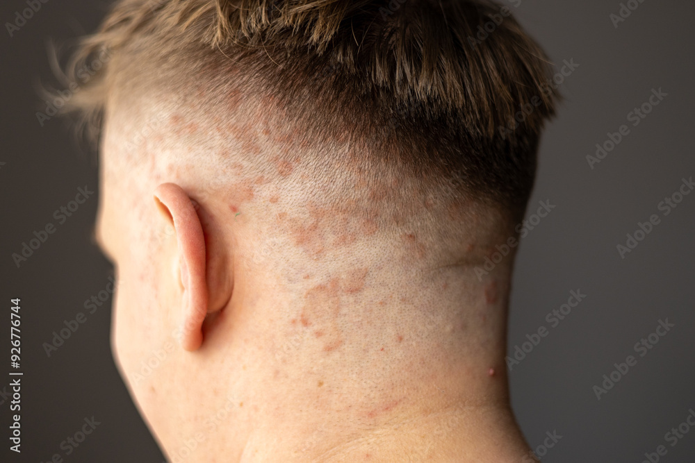 Psoriasis on the skin close-up, scalp, photos of dermatitis and eczema, skin problems concept, dermatology banner Psoriasis on the skin close-up, scalp, photos of dermatitis and eczema, skin problems concept, dermatology banner