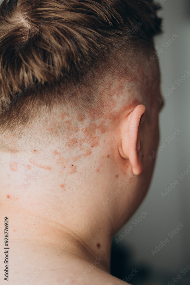 Psoriasis on the skin close-up, scalp, photos of dermatitis and eczema, skin problems concept, dermatology banner