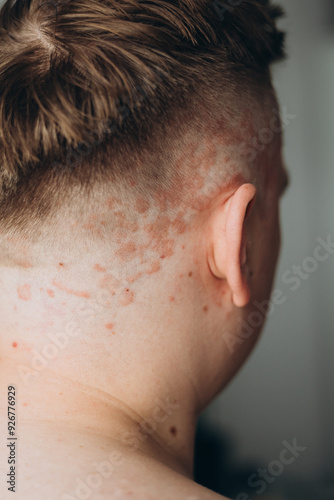 Obraz na płótnie Psoriasis on the skin close-up, scalp, photos of dermatitis and eczema, skin problems concept, dermatology banner w salonie