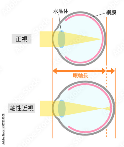 正視と軸性近視の眼球のシンプルな比較イラスト縦