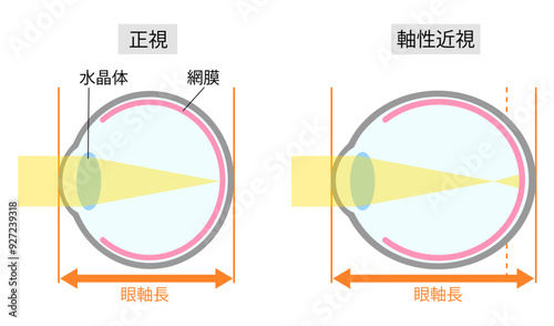 正視と軸性近視の眼球のシンプルな比較イラスト横