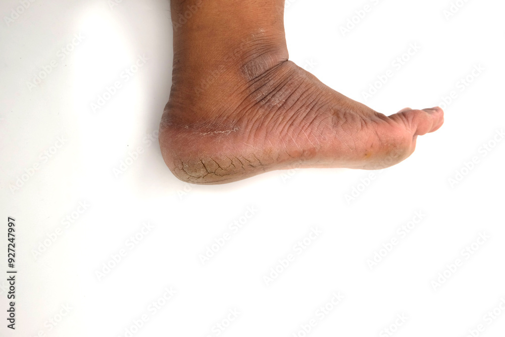 cracked heel, isolated on white background, Dry and cracked soles of feet cracked heel, isolated on white background, Dry and cracked soles of feet