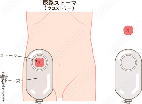 尿路ストーマ、ストーマ、ウロストミー、urostomy、オストメイト、イラスト、大腸、小腸、膀胱、illustration