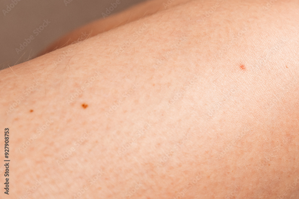 A close-up of skin with small moles, perfect for dermatology, skincare, or medical-themed projects. A close-up of skin with small moles, perfect for dermatology, skincare, or medical-themed projects.