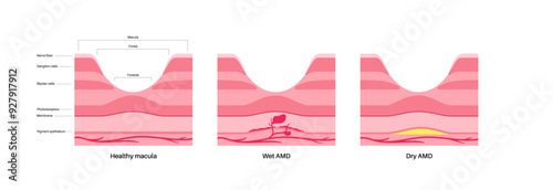 Macular degeneration poster