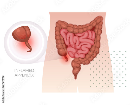  Appendicitis - Inflamed Appendix - Stock Illustration