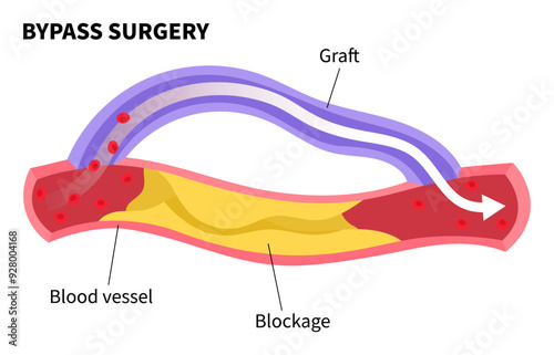 Bypass surgery for Peripheral artery disease with foot ulcer of clot leg veins by fatty or injury that cause pain and High blood pressure