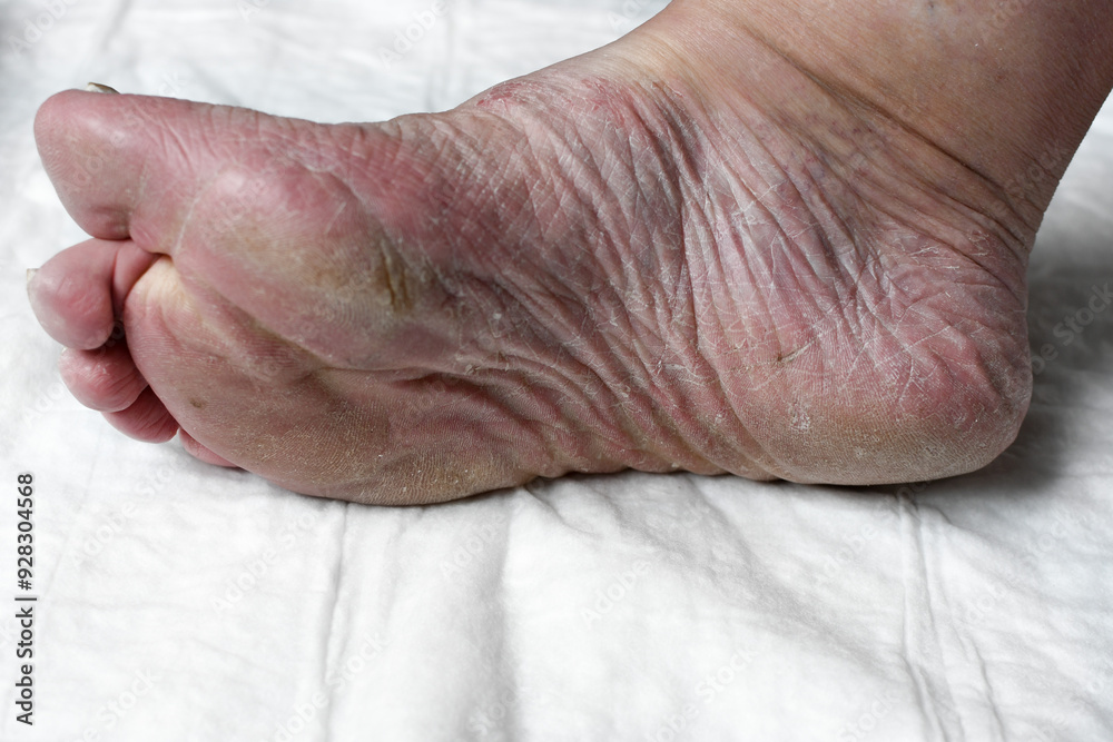 Fototapeta premium Skin damage, a wound on a woman's legs. Diseases of the skin. Damage to the nail plate, nail by a fungal disease