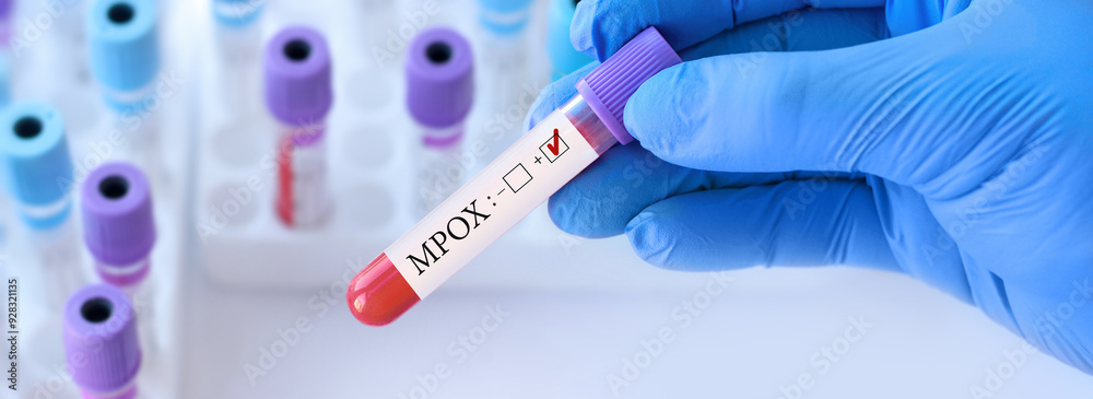 Naklejka premium Doctor holding a test blood sample tube with Monkeypox virus (MPXV) .The virus is transmitted from animals to humans. Infected people suffer from fever, cough, headache, nausea and vomiting