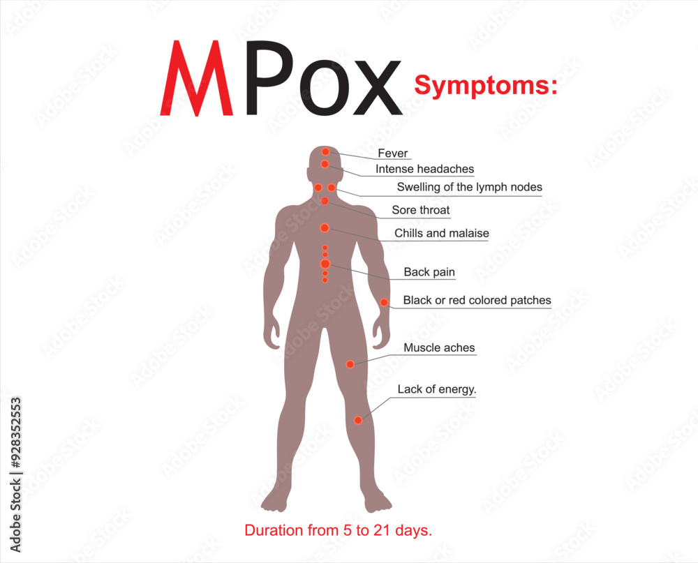 Monkey pox symptoms diagram. Vector flat illustration
Monkey pox symptoms diagram. Vector flat illustration