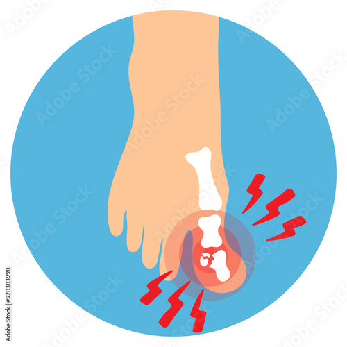 Toe Bone Fracture Illustration