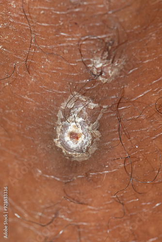 Close up of a molluscum contagiosum virus on skin photo