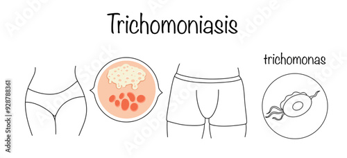 Trichomoniasis