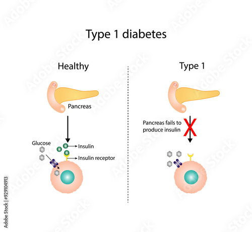 Diabetes mellitus type 1, pancreas's failure to produce enough insulin and type 2, cells fail to respond to insulin (Insulin resistance). Result in high blood glucose levels. Vector illustration