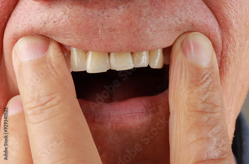 
Man demonstrating his two front Incisors teeth that are chipped
