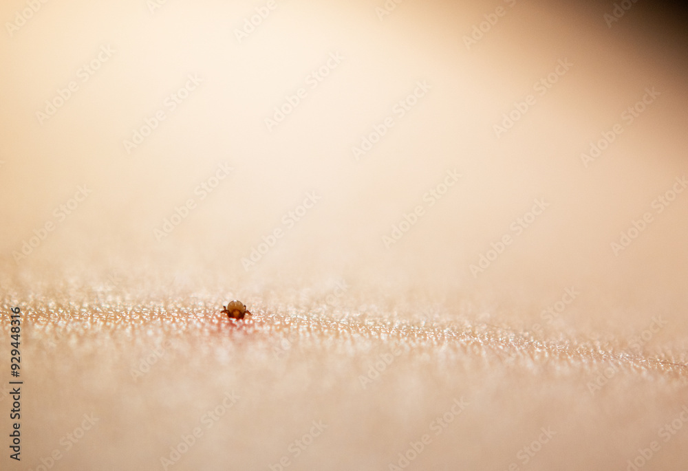 Obraz premium Close-Up of a Tick Embedded in Human Skin: Highlights Risks of Lyme Disease and Other Tick-Borne Illnesses