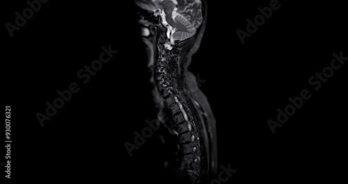 MRI of C-spine or magnetic resonance image of cervical spine sagittal view for diagnosis spondylosis and compression fracture.