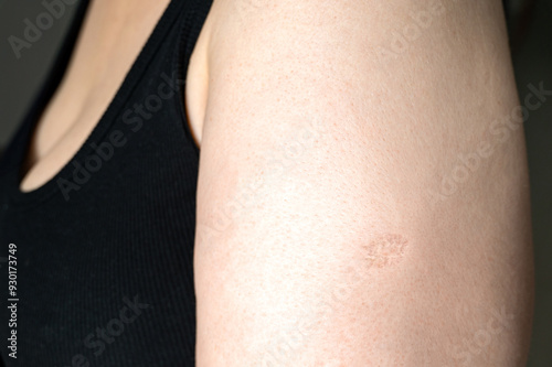 Obraz na płótnie BCG or TB vaccine scar marks Monkeypox and smallpox vaccines on a woman's left arm w salonie