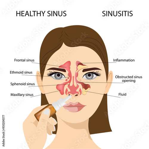 Sinusitis,  Female face with inflammation of the mucous membrane of the paranasal and frontal sinuses, nasal drops. Vector illustration for medical posters and educational materials