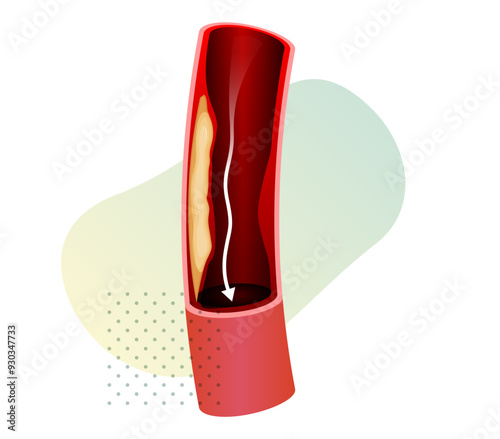 Restricted Blood Flow - Stock Illustration