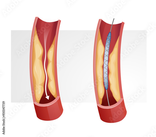 Heart Stent Procedure - Stock Illustration