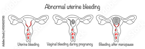 Abnormal uterine bleeding