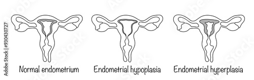 Endometrial hypoplasia. Endometrial hyperplasia