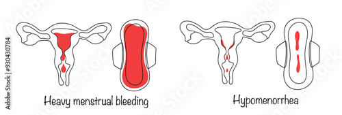 Menorrhagia. Hypomenorrhea