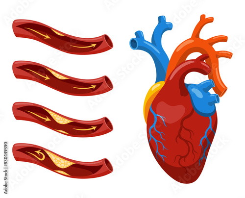 Atherosclerosis stages. Anatomy of heart attack. Arteriosclerotic vascular disease or ASVD. Atherosclerotic plaque in coronary artery. Vector illustration on white background