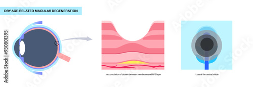 Macular degeneration poster