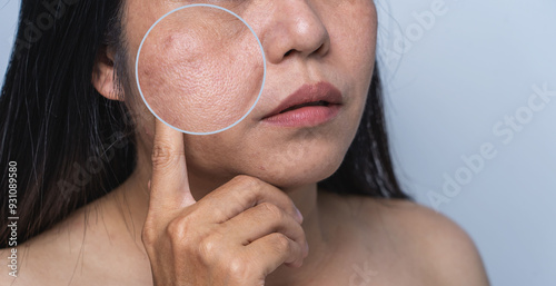 Foto Enlarged circles indicate facial skin problems such as blemishes, freckles, uneven skin tone and large pores on combination skin