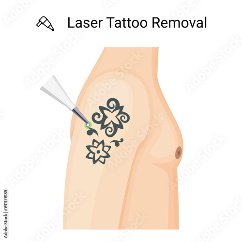 Laser Tattoo Removal Procedure on shoulder