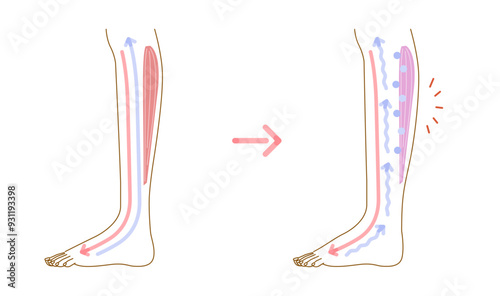 足のむくみ：むくみの発生原因イメージイラスト（断面図）