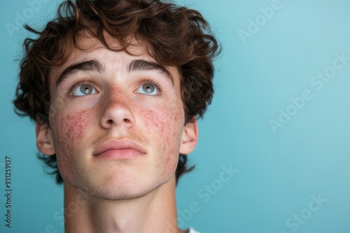 Young Man with Acne while thinking. 