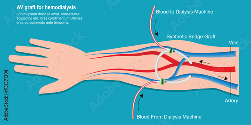 An arteriovenous (AV) graft is a type of access used for hemodialysis.
