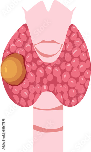 Thyroid disease Illustration 