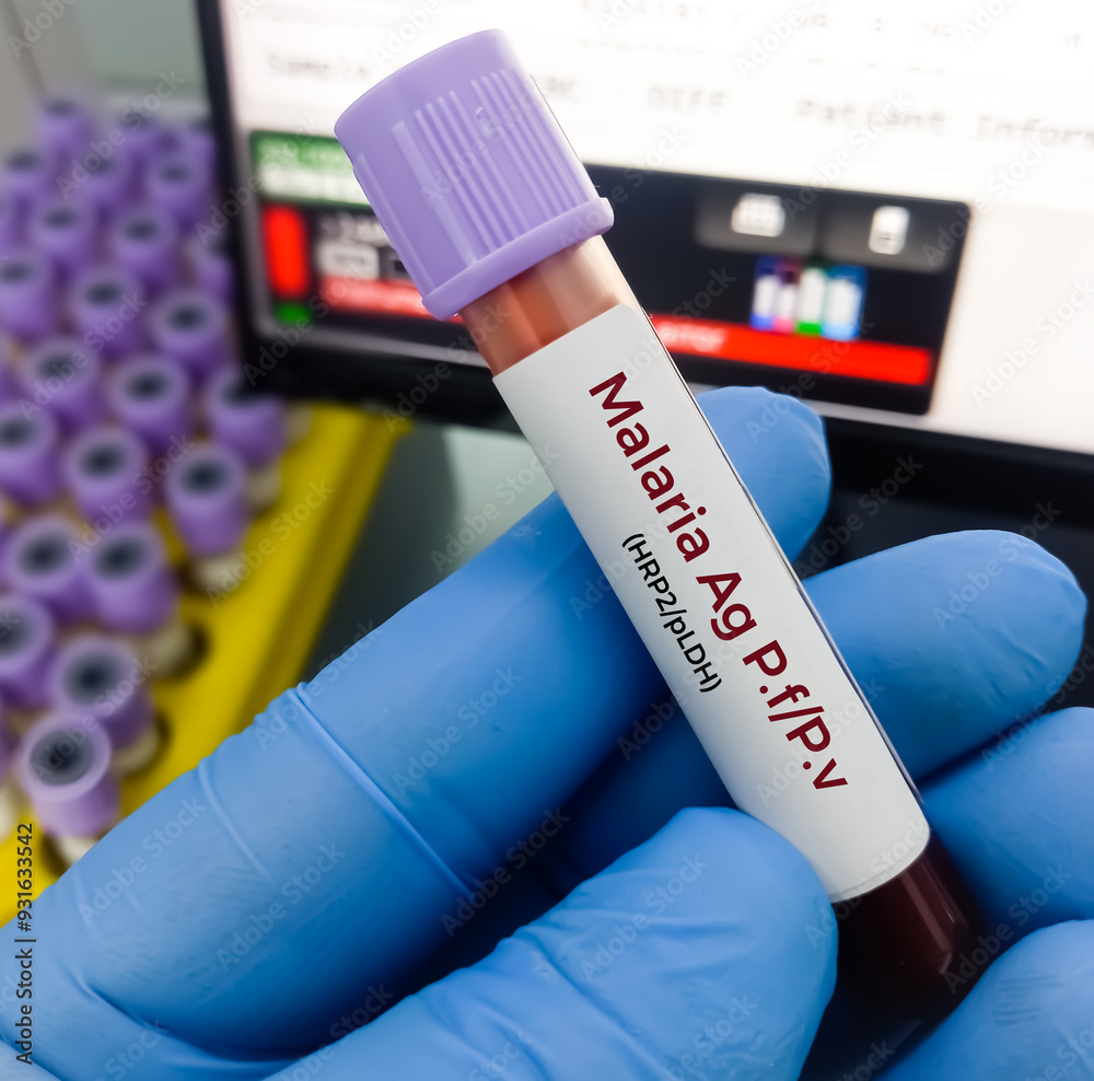 Blood sample for Malaria antigen test. Histidine Rich protein II (HRP2 ...