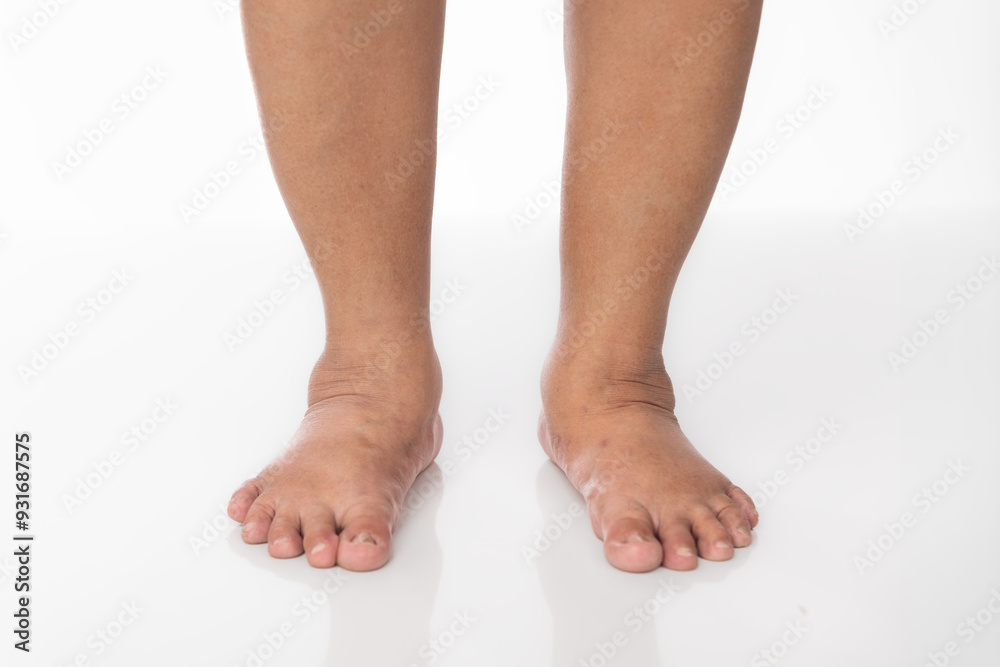 Overweight Senior Women and Ankle Swelling. Overweight Senior Women and Ankle Swelling.