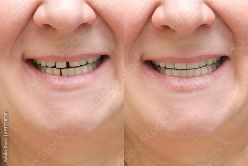 Collage of woman with diastema between upper front teeth before after treatment,showing big gap crack,older middle aged female needs stomatology dentist,medicine healthcare close up. photo