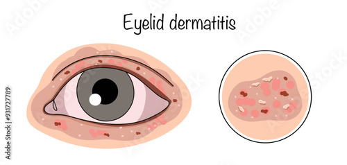 Eyelid dermatitis