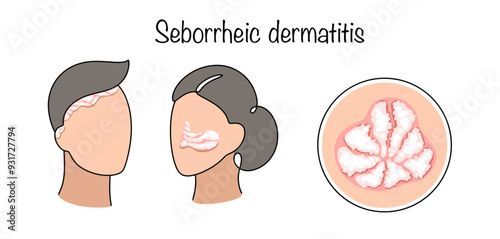 Seborrheic dermatitis