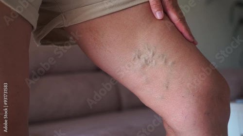 Close-up shot of a mature woman's thigh showing varicose veins, highlighting the natural effects of aging on the skin and vascular health