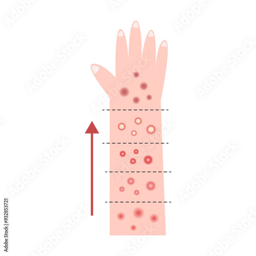 mpox, monkey pox disease. 