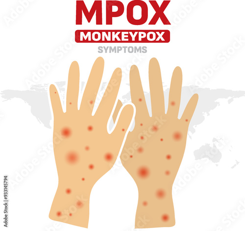 Infected person's hands with Mpox monkeypox virus. Illustration of visible rash and red lesions symptoms of the Monkeypox virus.