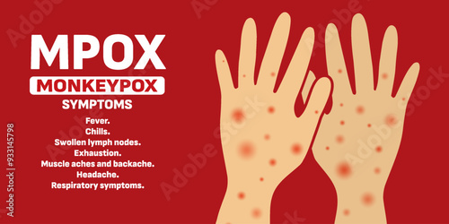 Infected person's hands with Mpox monkeypox virus. Illustration of visible rash and red lesions symptoms of the Monkeypox virus.